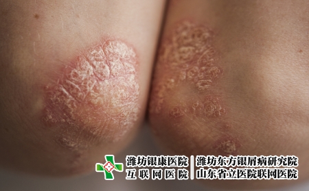攝圖網_326238053_身穿白色T恤的年輕女子手肘皮膚上的絲蟲病癥狀發(fā)癢皮炎疾病衛(wèi)生保健濕疹皮膚科女性女孩（企業(yè)商用）