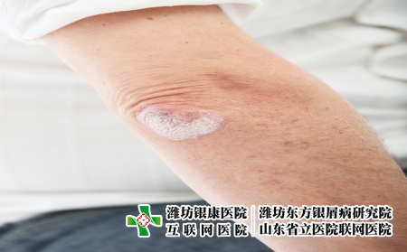 攝圖網(wǎng)_321241037_絲蟲病皮膚或決定肘肘（企業(yè)商用）