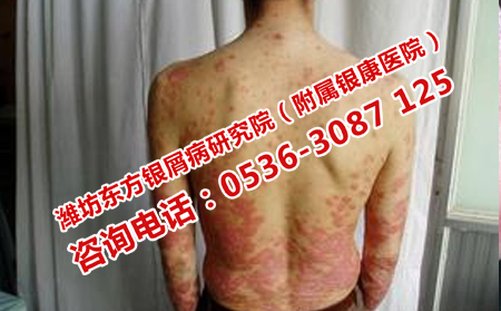 心態(tài)對(duì)牛皮癬的治療有什么作用