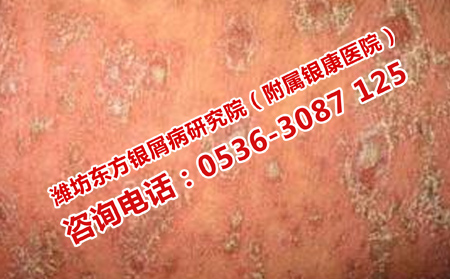 治療牛皮癬的關(guān)鍵是什么