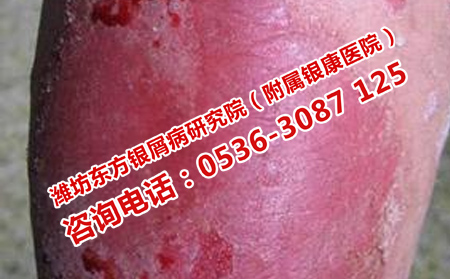 牛皮癬怎么護(hù)理理想