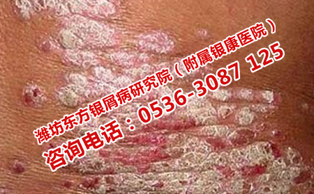牛皮癬的預(yù)防方法有哪些