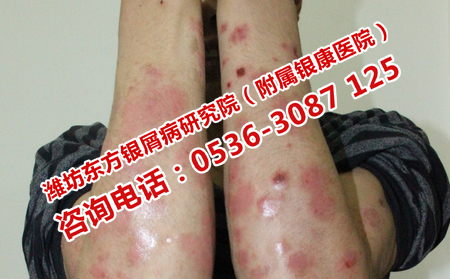 如何治療復發性牛皮癬