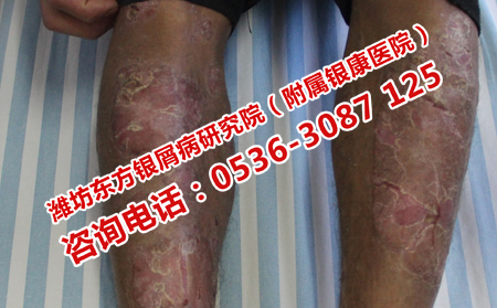 牛皮癬患者日常應該注意什么問題