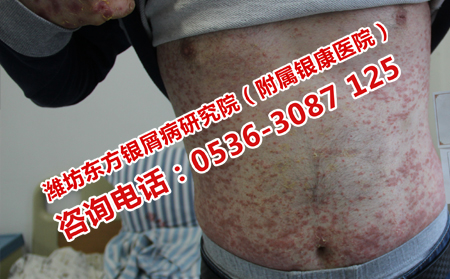總是反復的牛皮癬治療