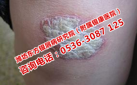 治膿皰型牛皮癬治療效果理想的醫(yī)院