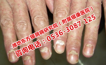 關節型牛皮癬疼痛怎么辦