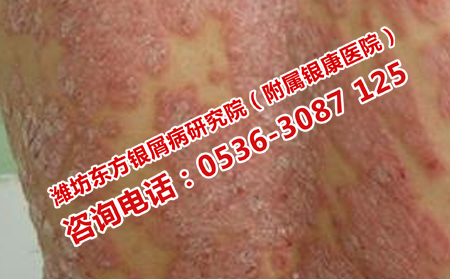 三個治療牛皮癬的誤區(qū)