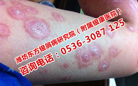 如何預(yù)防牛皮癬復發(fā)