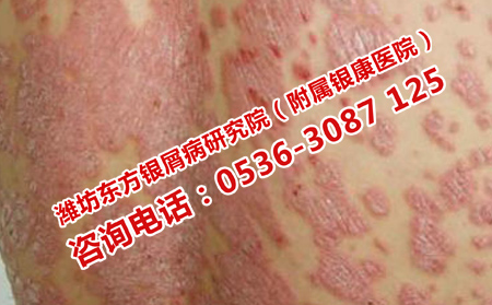 頑固的牛皮癬去濰坊哪個醫(yī)院治療