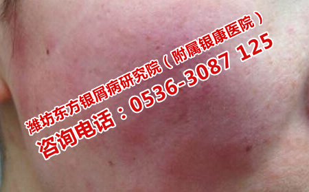 如何預(yù)防牛皮癬的嚴(yán)重危害