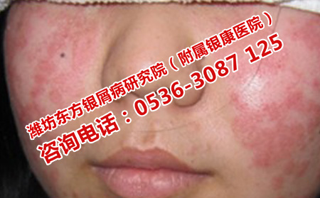 曬太陽預(yù)防牛皮癬復(fù)發(fā)