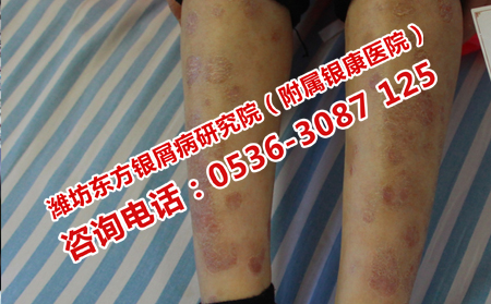 銀屑病恢復(fù)之后需要護(hù)理