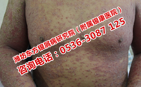 濰坊看銀屑病的專門醫院