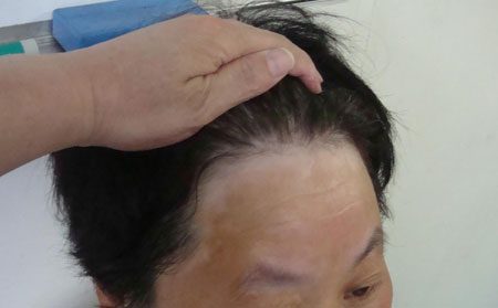 預(yù)防白癜風(fēng),白癜風(fēng)預(yù)防要點(diǎn),濰坊白癜風(fēng)醫(yī)院