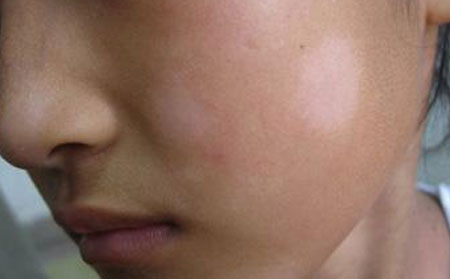 青少年白癜風(fēng)的癥狀