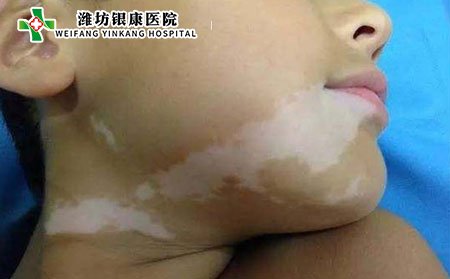 兒童白癜風(fēng)護(hù)理,兒童白癜風(fēng)護(hù)理事項(xiàng)