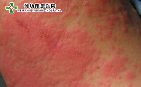 泛發(fā)性濕疹,泛發(fā)性濕疹護理