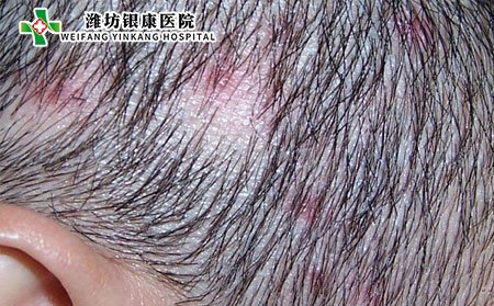 脫發(fā)性毛囊炎怎么辦?能自愈嗎?