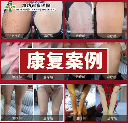 銀屑病皮膚病專家會(huì)診康復(fù)案例